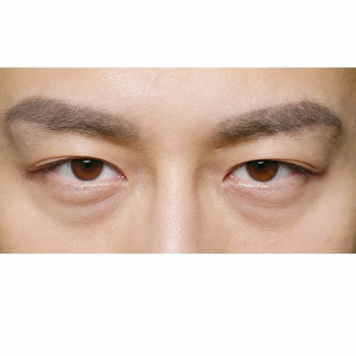 眼袋浮腫下垂示意圖